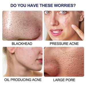 Parches Hidrocoloides para el Acné, 78 Unidades, Venta al por Mayor de Fábrica, Adhesivos para Granos y Espinillas Faciales - Product Image 2