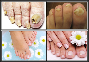 Máquina Láser 3 en 1 para Onicomicosis, Podología, Eliminación de <span class=keywords><strong>Hongos</strong></span> en las <span class=keywords><strong>Uñas</strong></span>, Eliminación Vascular con Láser 980, Endoláser - Product Image 3