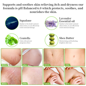 Etiqueta privada Abdomen línea floja embarazo estrías reparación cicatriz antiestrías crema de eliminación de marcas - Product Image 3