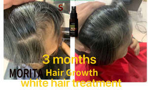 Nuevo Sérum Capilar Natural de Jengibre para el Crecimiento Rápido del Cabello, Spray para el Cuero Cabelludo, Tratamiento para la Caída del Cabello, Detiene la Pérdida de Cabello, con Biotina para Hombre y Mujer - Product Image 6