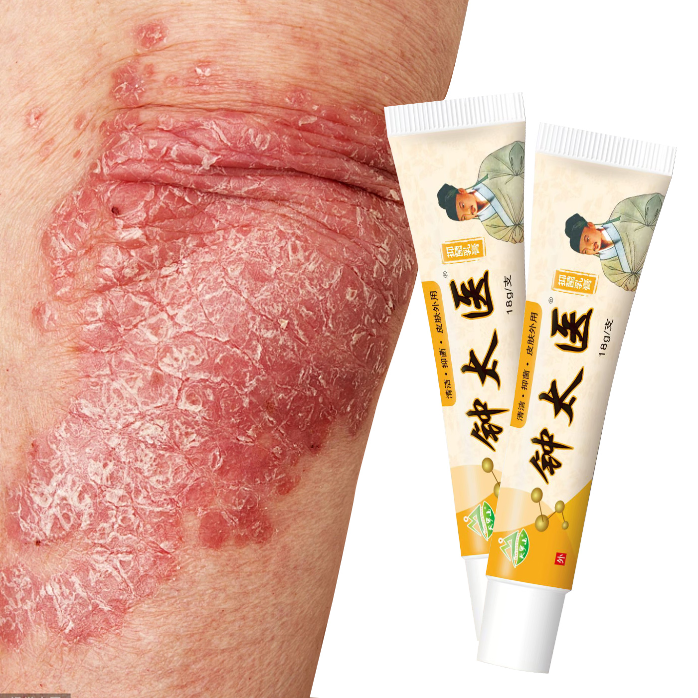 Zhong Tai Yi Tinea Dermatitis Ointment OEM External Application Chinese Herbal Medicine 18g Antibacterial Support Customized