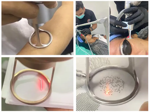 Dispositivo Láser Fraccional de CO2 Más Vendido para Eliminación de Cicatrices, Rejuvenecimiento Vaginal y de la Piel, Máquina de Sistema de CO2, Cepillo de Limpieza Facial - Product Image 5