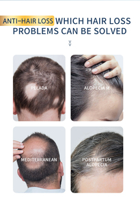 Minyak Rambut Organik Rosemary Kelapa Alpukat untuk Pertumbuhan Anti-Rontok Perawatan Penguatan dengan Minyak Esensial untuk Pria & Wanita 150ml - Product Image 4