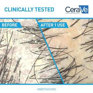 Shampooing hydratant antipelliculaire 100% 19 Oz avec 1% de pyrithione de zinc pour tous types de cheveux - Product Image 4