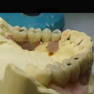 กล้องส่องทางไกลแบบครอบฟันรองรับฟันปลอม ivoclavar scheftner ผลิตตามสั่งไทเทเนียมห้องปฏิบัติการทันตกรรมจีน - Product Image 3