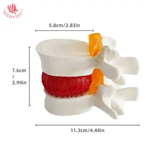 Frt039 Lumbale Hernia Model Knijpen Om Het Bloedende Anatomische Model Van Één Sectie Menselijke Lumbale Wervelkolom Aan Te Tonen