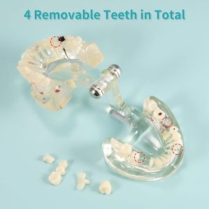 Modelo Dental Patológico Transparente con Dientes de Resina Removibles y Ángulo Ajustable para Enseñanza y Entrenamiento sobre Enfermedades - Product Image 3