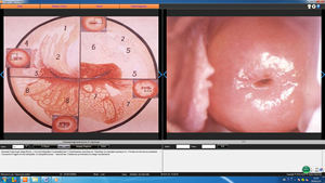 Colposcopio óptico Video digital <span class=keywords><strong>Vagina</strong></span> ginecológica óptica para Ginecología Software de colposcopio electrónico para Ginecología - Product Image 6