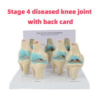 Outil d'affichage d'enseignement orthopédique en 4 étapes Modèle d'articulation du genou malade avec cartes Produit scientifique médical