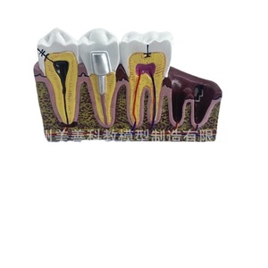 Modelo de patología dental completo 6x, un modelo didáctico que demuestra la anatomía de dientes humanos con caries y raíces afectadas. - Product Image 4