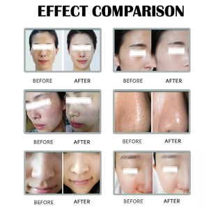 Máy làm săn chắc da bằng tần số vô tuyến chuyên nghiệp năm 2023, sử dụng ánh sáng LED và vi kim RF - Product Image 6