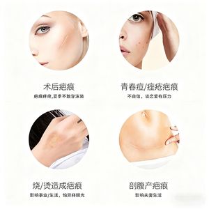 Pansement hydrocolloïde en rouleau transparent 0,3 mm 0,38 mm épaisseur personnalisable protection usage médical - Product Image 3