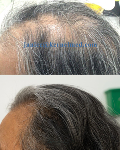 Fabricante Médico Certificado ISO con 29 Años de Experiencia, Proveedor de Máquinas para el Crecimiento del Cabello Lllt, Tratamiento Láser para la <span class=keywords><strong>Alopecia</strong></span> Androgenética - Product Image 6