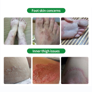 Crème apaisante contre les démangeaisons à la formule naturelle 30g - Apaise les irritations cutanées, non grasse et testée dermatologiquement - Product Image 3