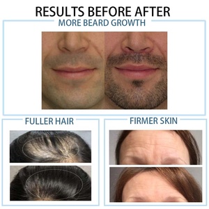 Meilleur pour les hommes Home Derma Rolling System Microneedle Roller pour la croissance des <span class=keywords><strong>cheveux</strong></span> du cuir chevelu et de la barbe Traitement du visage ciblé - Product Image 3