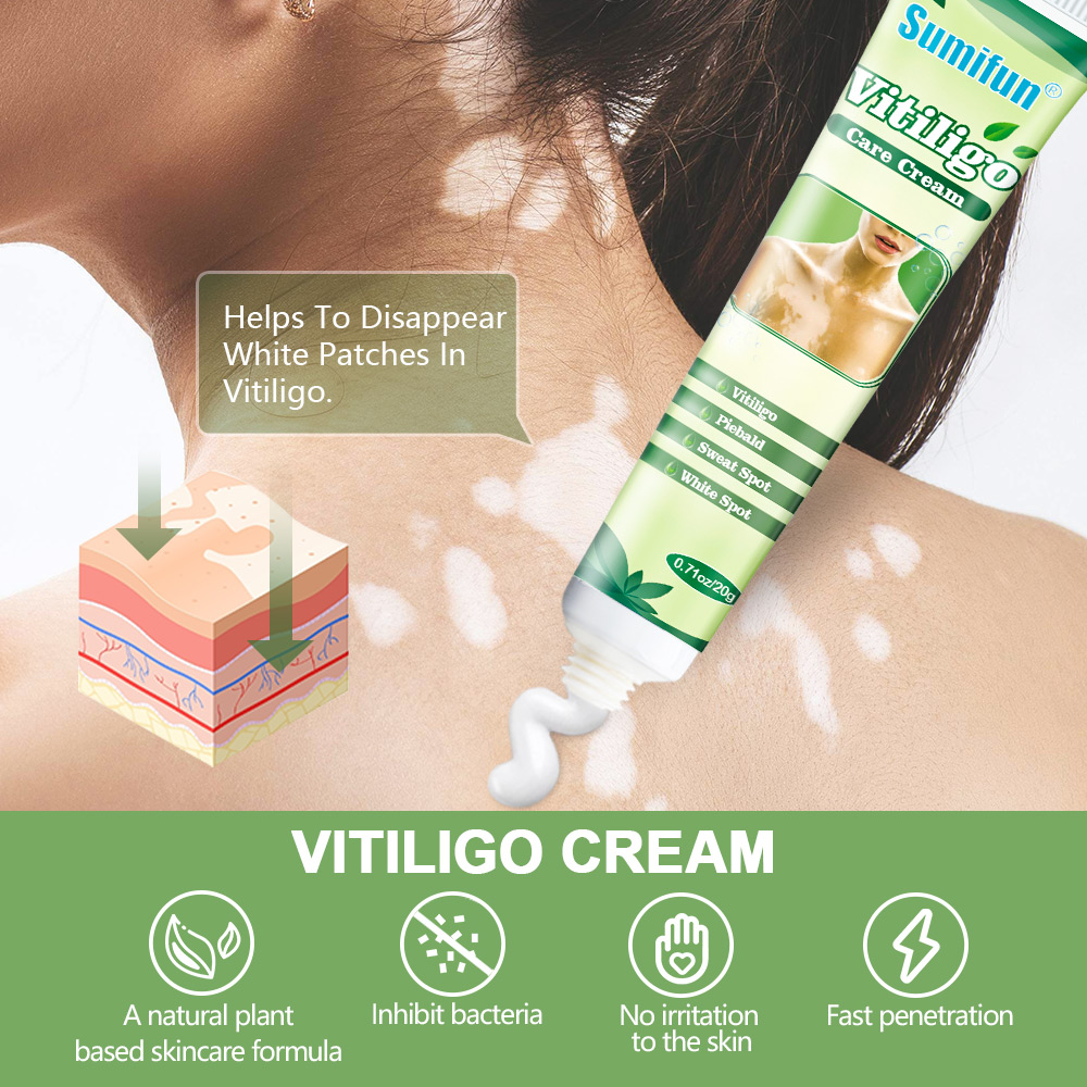 Hot sell White Spot Vitiligo Treatment Cream Herbal Vitiligo Therapeutic Creams Relieve Psoriasis Eczema Vitiligo Ointment