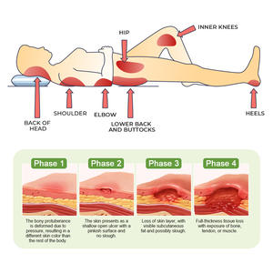 Crème en gros pour le traitement des escarres, pommade naturelle et biologique pour les plaies de pression myogènes et les escarres, crème de soin des escarres - Product Image 5