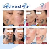 Limpiador Facial Newstyle Skin Scrubber Hydro 5 en 1, Microdermoabrasión, Hidrofacial, Máquina de Limpieza Facial con Vacío, Limpieza Profunda, Cuidado de la Piel
