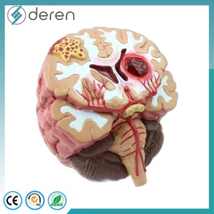 Modelo de Cerebro para Epilepsia Tipo Maniquí, Material PLA, para Hemorragia Cerebral, Malformación Arteriovenosa, Patología - Product Image 2