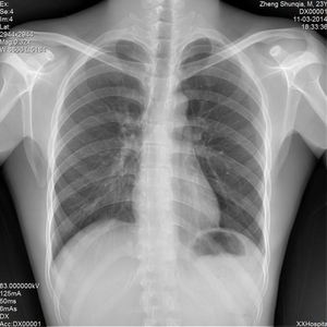 Портативный беспроводной цифровой рентгеновский детектор Iray X-Ray Machine (14*17 дюймов) для плоских панелей - Product Image 3