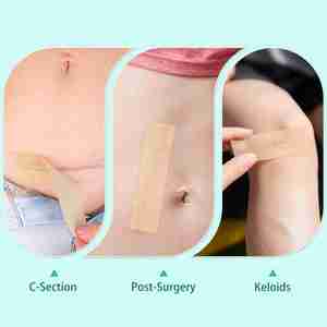 Cinta de Silicona para Cicatrices, 6 Unidades - Cinta de Silicona de Grado Médico para Cicatrices Quirúrgicas, Láminas de Silicona Reutilizables para Cicatrices de Cesárea, Cirugía - Product Image 5