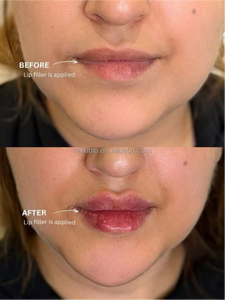 Relleno Dérmico Labial Seguro y <span class=keywords><strong>de</strong></span> Alta Calidad para una <span class=keywords><strong>Aumento</strong></span> Labial Sutil, para Obtener <span class=keywords><strong>Labios</strong></span> Voluminosos y Suaves <span class=keywords><strong>con</strong></span> una Textura Natural - Product Image 3
