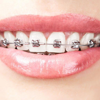 Matériel dentaire orthodontique multi-usages pour l'hygiène buccale, attaches orthodontiques métalliques auto-ligaturantes Roth Active.