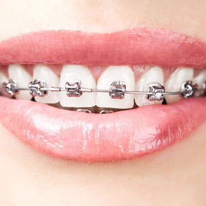 Apparecchiature odontoiatriche per l'igiene orale multiuso Roth attivo in metallo auto-legante parentesi ortodontiche - Product Image 4