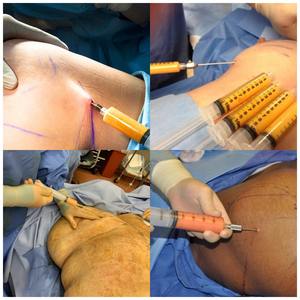 Fat Collection Transfer Fat Grafting Luer Lock Blunt Syringe Liposuction Cannula - Product Image 5