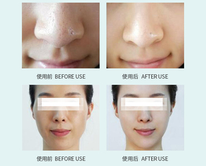 Nuovo Design di qualità medica microdermoabrasione macchina Appareil De microdermoabrasione filtro per microdermoabrasione - Product Image 5