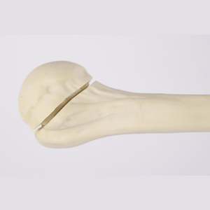Kyrenmed cortical <span class=keywords><strong>humerus</strong></span> ขวา fractureed กับ <span class=keywords><strong>proximal</strong></span> <span class=keywords><strong>humerus</strong></span> <span class=keywords><strong>fracture</strong></span> สำหรับการประชุมเชิงปฏิบัติการการตัดเจาะ - Product Image 3