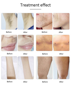 เครื่องกำจัดขนด้วยเลเซอร์ไดโอดแบบพกพา 808 นาโนเมตร สำหรับทุกสภาพผิว เพื่อความงาม - Product Image 6