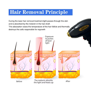 2026 New 2 In1 Blackhead Removal Pore Cleanings Tattoo Removal and 3 Wavelength Diode Lase Hair Removal Machine - Product Image 6