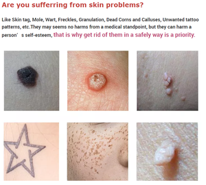 ปากกาพลาสมาไฟโบรบลาสต์ กำจัดไฝ กระ จุดด่างดำ รอยสัก หูด กำจัดรอยแผลเป็น ขายดี - Product Image 3