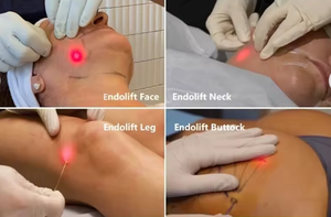 Appareil de liposuccion Microair, laser diode 1470 nm, laser facial à fibre 980 nm, lifting du visage, double <span class=keywords><strong>menton</strong></span>, lipo laser, lifting du visage - Product Image 6