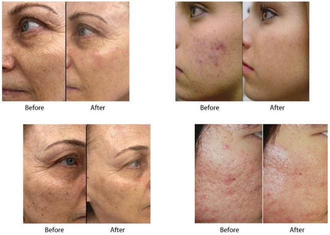 Fractional Microneedling RF Radio Frequency Microneedling Microneedle Radiofrequency Micro Needle Fractional Rf