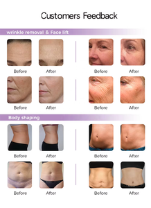 Apparecchiatura Professionale ad Alta Energia per la Bellezza, Ringiovanimento della Pelle, Riduzione Rughe, Rassodamento Viso e Corpo, Certificata CE per Uso Cosmetico - Product Image 6