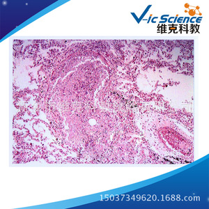 Lung abscess biological section, medical histology, <b>microscope</b> for teaching and research, medical school laboratory. - Product Image 5