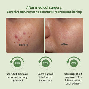 Soin de la peau vegan bio de marque privée Sérum apaisant anti-allergie <span class=keywords><strong>visage</strong></span> Essence apaisant réparant les rougeurs pour peaux sensibles - Product Image 2