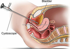 एंडोस्कोपी कैमरा साइटोस्कोप एचडी कठोर सर्जिकल 4 मिमी 0 30 70 डिग्री साइस्टोस्कोपी एंडोस्कोप - Product Image 4