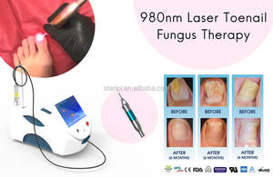 Mesin <span class=keywords><strong>Laser</strong></span> Diode 980nm untuk Pengobatan Jamur Kuku Onikomikosis, Podiatri, Kutil Telapak Kaki, Onikomikosis - Product Image 5