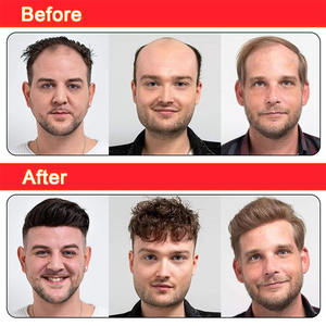 Système de remplacement capillaire pour hommes, base en peau, cheveux indiens Remy vierges les plus naturels et durables, longueur 6 pouces, densité 80%-150%, ondulation profonde - Product Image 5