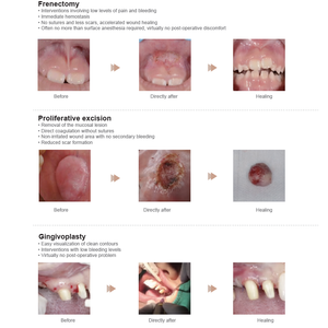 Nouveauté Laser 650mm 980 mm longueur d'onde plus grande veine saphène veineuse Ablation Laser équipement de chirurgie - Product Image 4