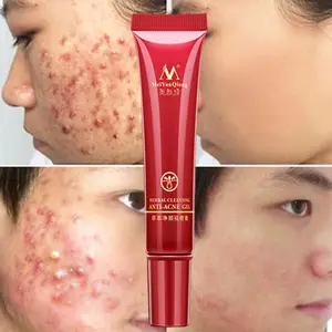 Herbal Acne Removing Cream Facial Acne Cleansing Cream Skin Care Remove Blackhead Pimple Acne Treatment Creams