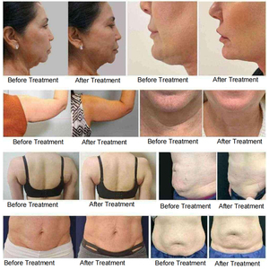 Chất béo Loại bỏ máy trusculpt ID Flex cơ thể điêu khắc máy da thắt chặt mỹ viện - Product Image 2