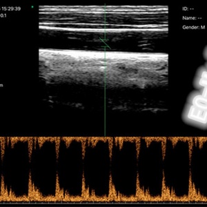 Sonde échographique linéaire sans fil mini CU13-R à double fréquence 10 et 14 MHz, pour ponction avec kit de guidage, Doppler couleur, 128 éléments - Product Image 4