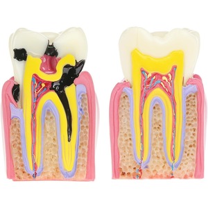 Modelo Educativo de Caries Dentales, Ampliado 6 Veces en Sección Transversal, Material de Resina para Educación Anatómica y Enseñanza de Salud Dental - Product Image 5