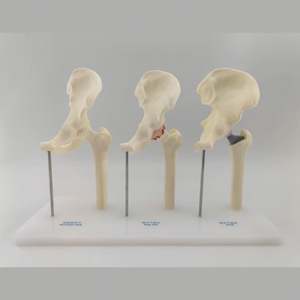 KyrenMed 3-ступенчатая модель лечения и замены остеоартрита тазобедренного имплантата - Product Image 3