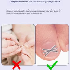 "Kit Corrector de Uñas Encarnadas-Soporte Ajustable de Metal y Silicona para Aliviar el Dolor, Adultos y Niños con Caja de Almacenamiento" - Product Image 6
