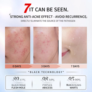 Novo Equipamento de <span class=keywords><strong>Spa</strong></span> 2025 Usado para Tratamento de Manchas Faciais, Verrugas, Acne e Rejuvenescimento da Pele Facial para Uso em Salão - Product Image 4